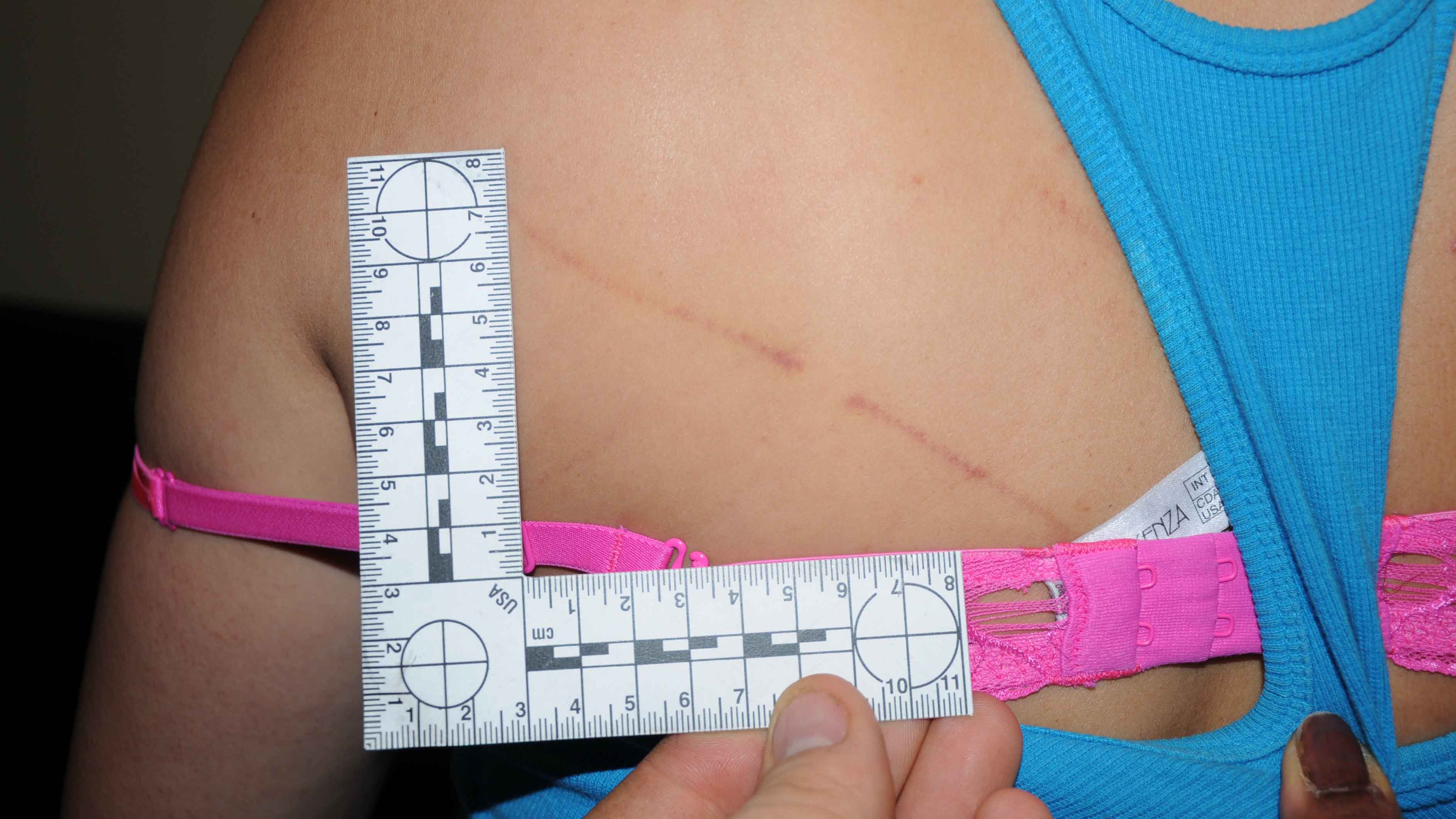 Photo of scratches victim allegedly received at the hands of suspended Senator Patrick Brazeau.